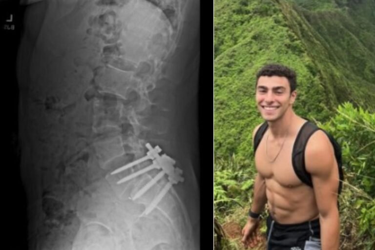 Saiba qual é a doença de Luigi Mangione, suspeito de assassinar CEO