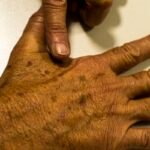 Câncer de pele: falta de dados sobre pacientes dificulta prevenção