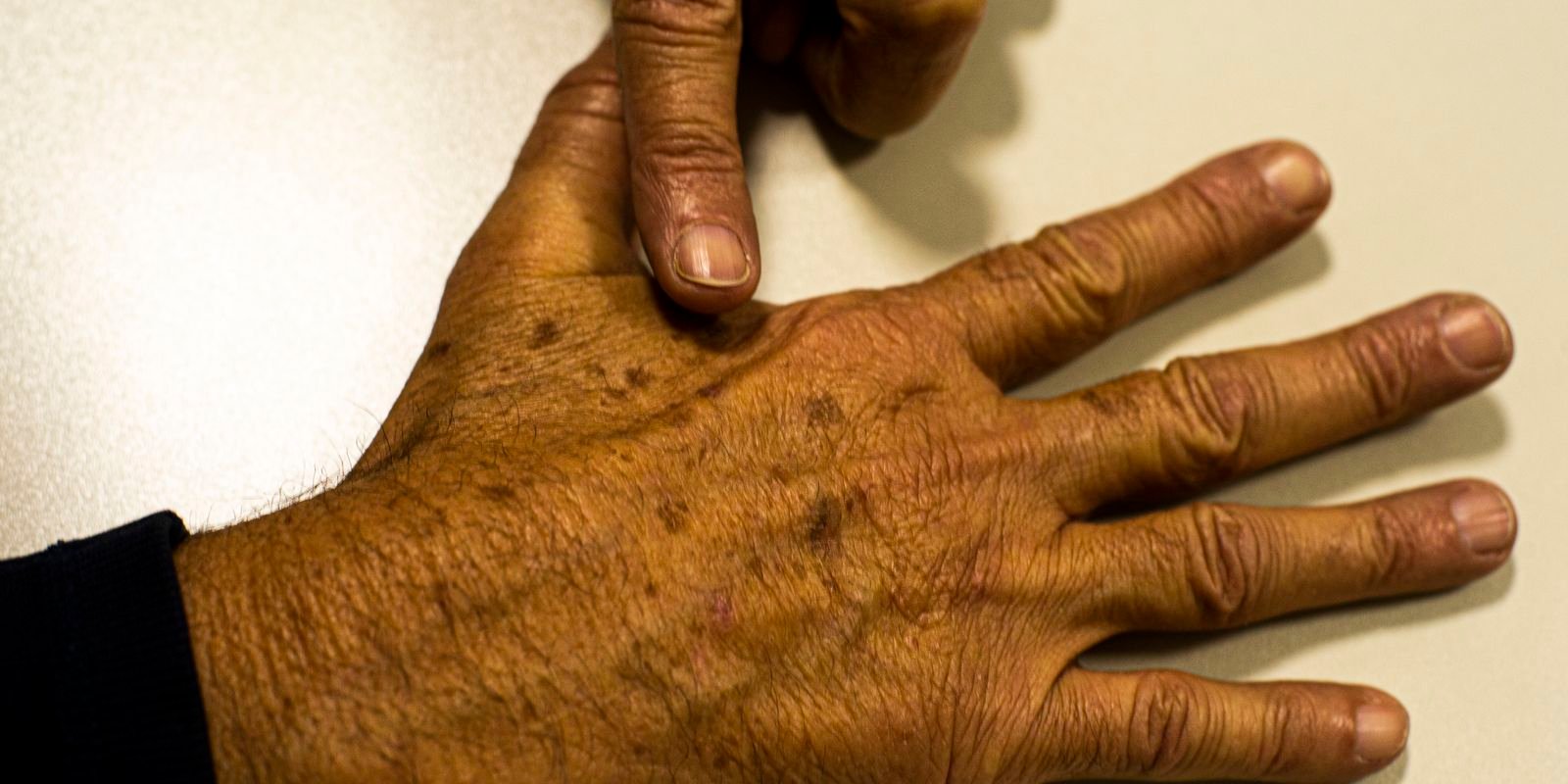 Câncer de pele: falta de dados sobre pacientes dificulta prevenção