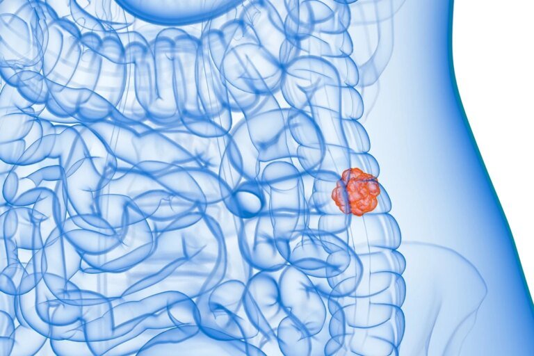 SUS adotará exame não invasivo para identificar câncer de intestino