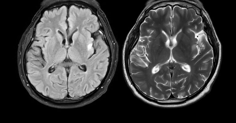 Cientistas descobriram um novo gatilho para o Alzheimer e um medicamento que o inibe
