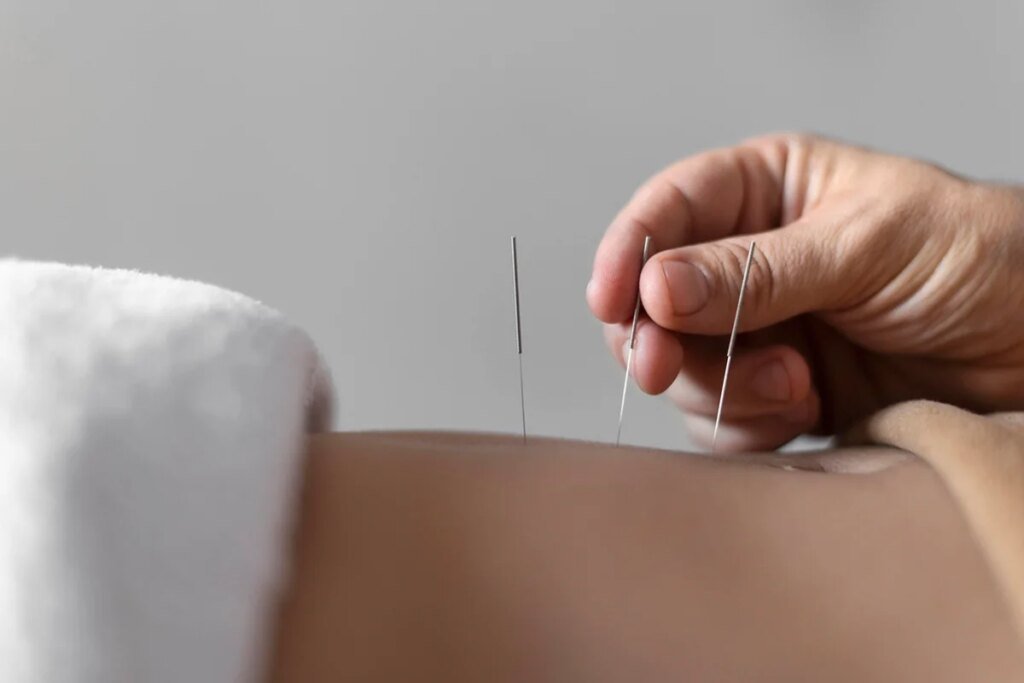 acupuntura auxilia tratamento tradicional, mas não o substitui