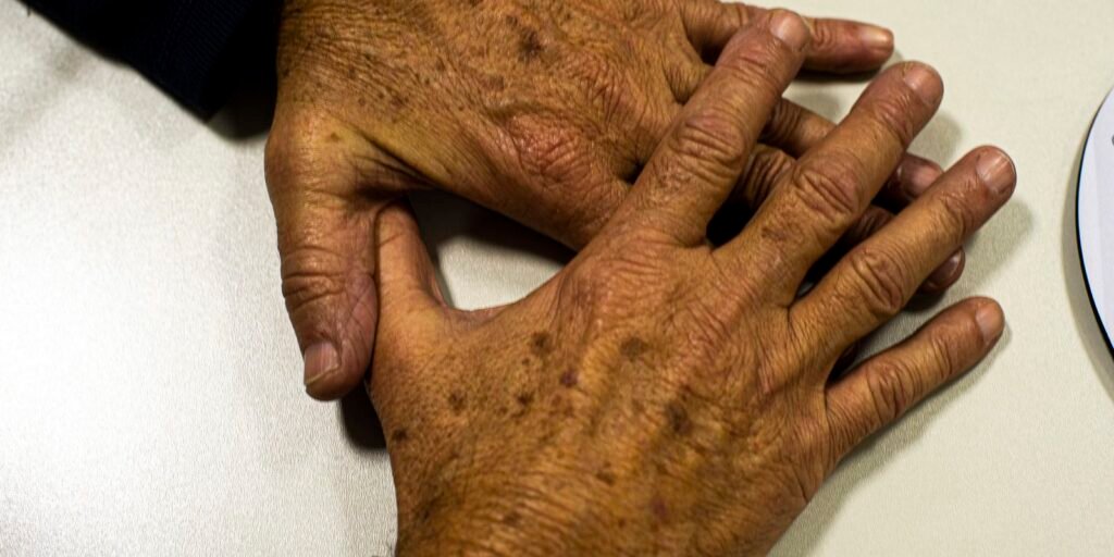 País deve registrar 9 mil novos casos de melanoma, nem sempre na pele