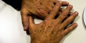 País deve registrar 9 mil novos casos de melanoma, nem sempre na pele