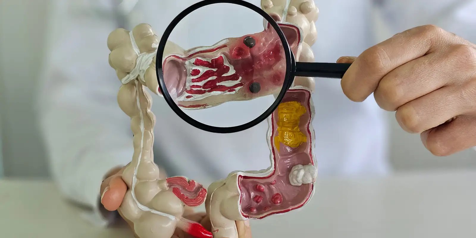 Muito frequente, câncer de intestino pode não apresentar sintomas